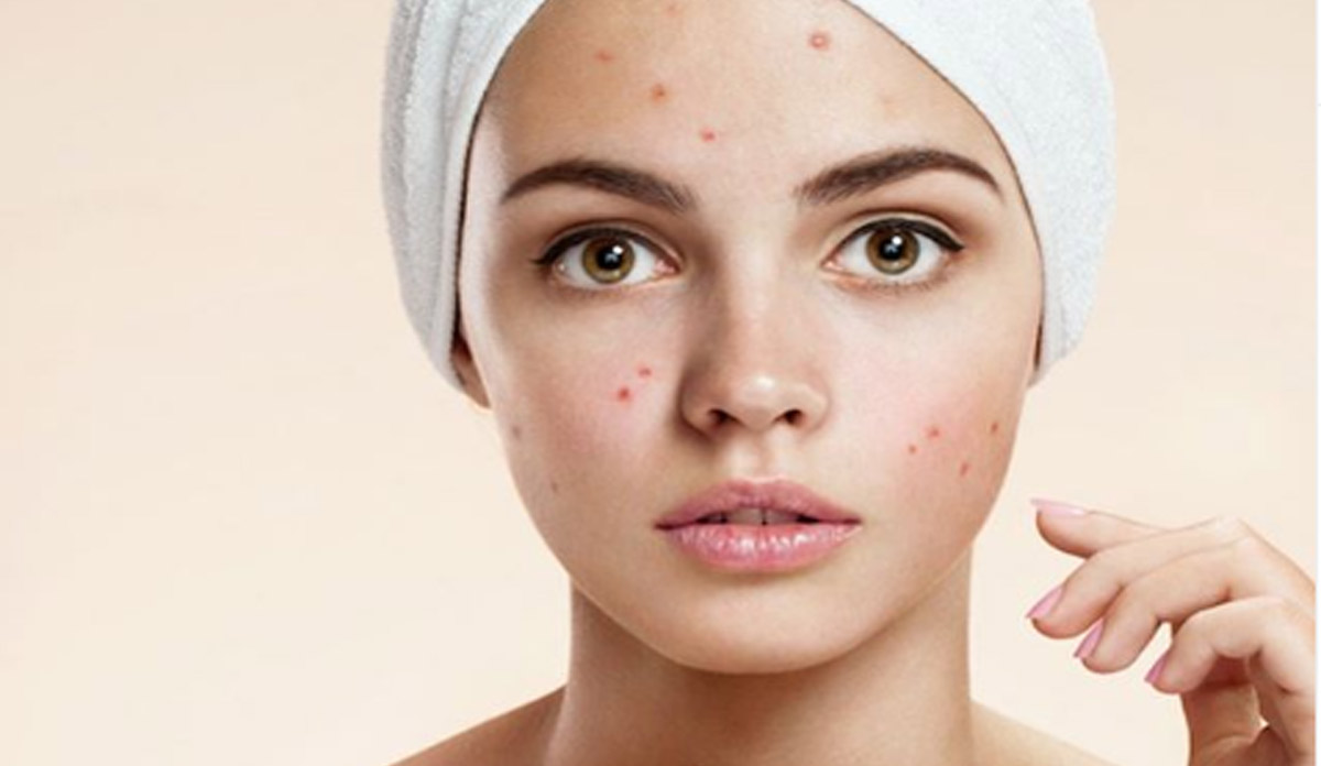 home remedies acne