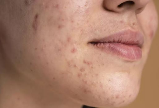 home remedies acne