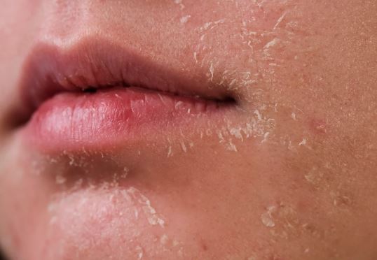 Dry skin should take special care