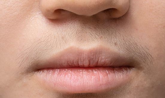 Unwanted hair on upper lip, forehead or face